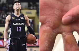 郭艾伦手指触目惊心 辉煌背后有太多不为人知的心酸