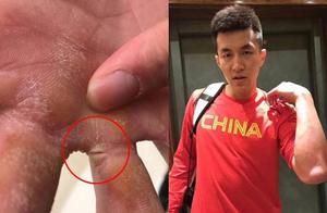 心疼！郭艾伦打球手肿到变形+1CM明显裂口 这是怎样的痛苦？