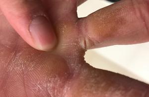 “CBA第一帅”却有只看着吓人的右手 虎口开裂手指变形让人心疼